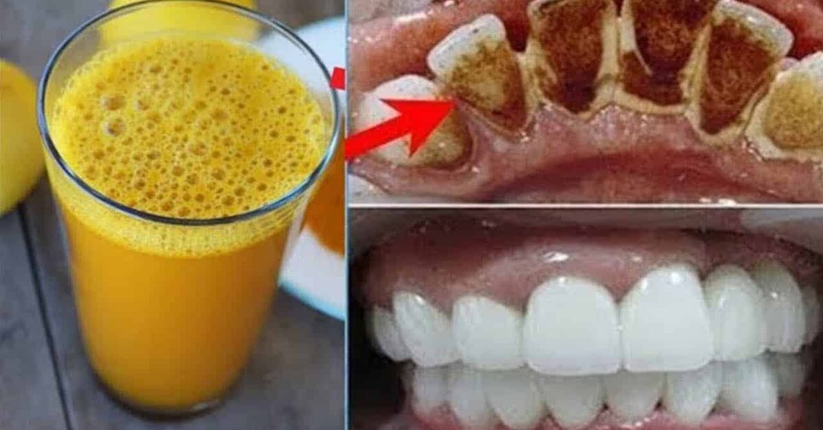 2 Dakika İçinde Sarı Dişlere Ev Yapımı Doğal Çözüm