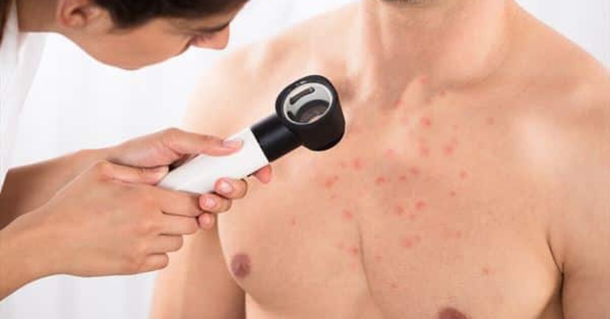 Ağda Sonrası Sivilce Nasıl Geçer?