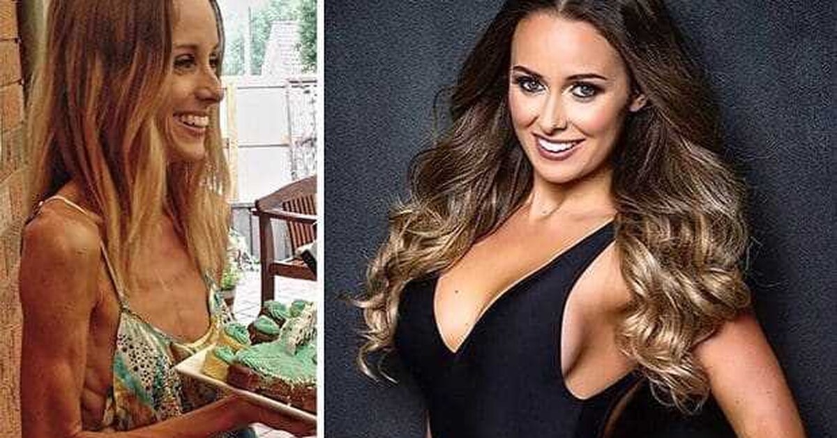 Anoreksiya Hastalığı Nedir, Bitkisel Tedavisi