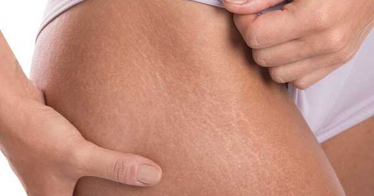 Bacaktaki Çatlaklara Ne İyi Gelir?