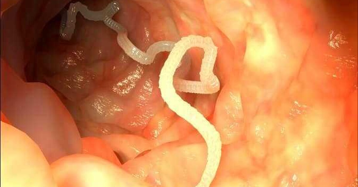 Bağırsak kurtları (solucanları) neden olur?