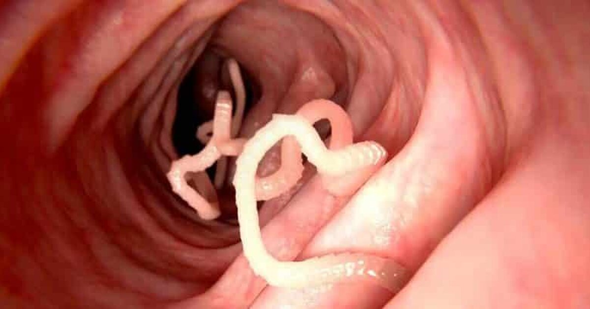 Bağırsakta Oluşan Amip Paraziti Tedavisi İçin Bitkisel Kür