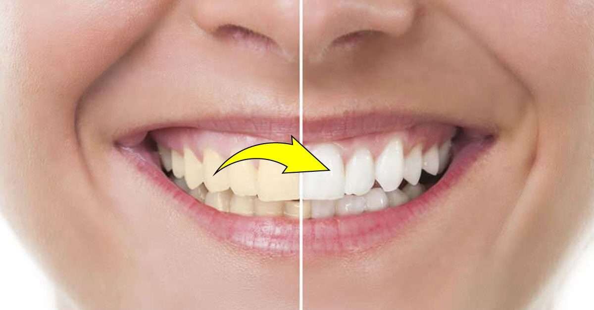 Bembeyaz Dişler İle Gülüşlerinize Can Katın