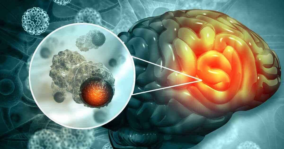 Beyinde Lezyon Bitkisel Tedavisi: Doğal Yöntemler ve Öneriler