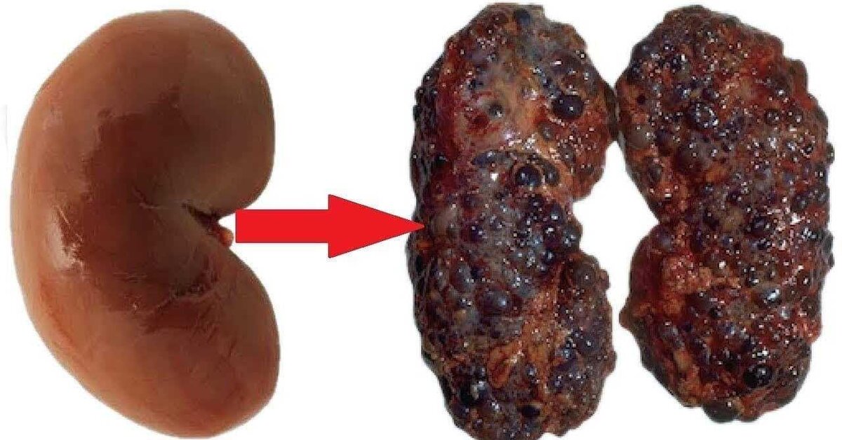 Böbreklere Zarar Veren Alışkanlıklar