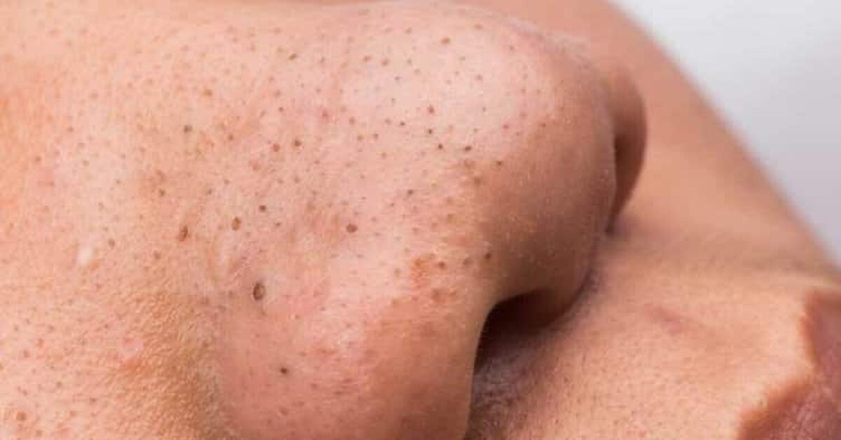 Burunda Oluşan Siyah Noktalara Savaş Açın