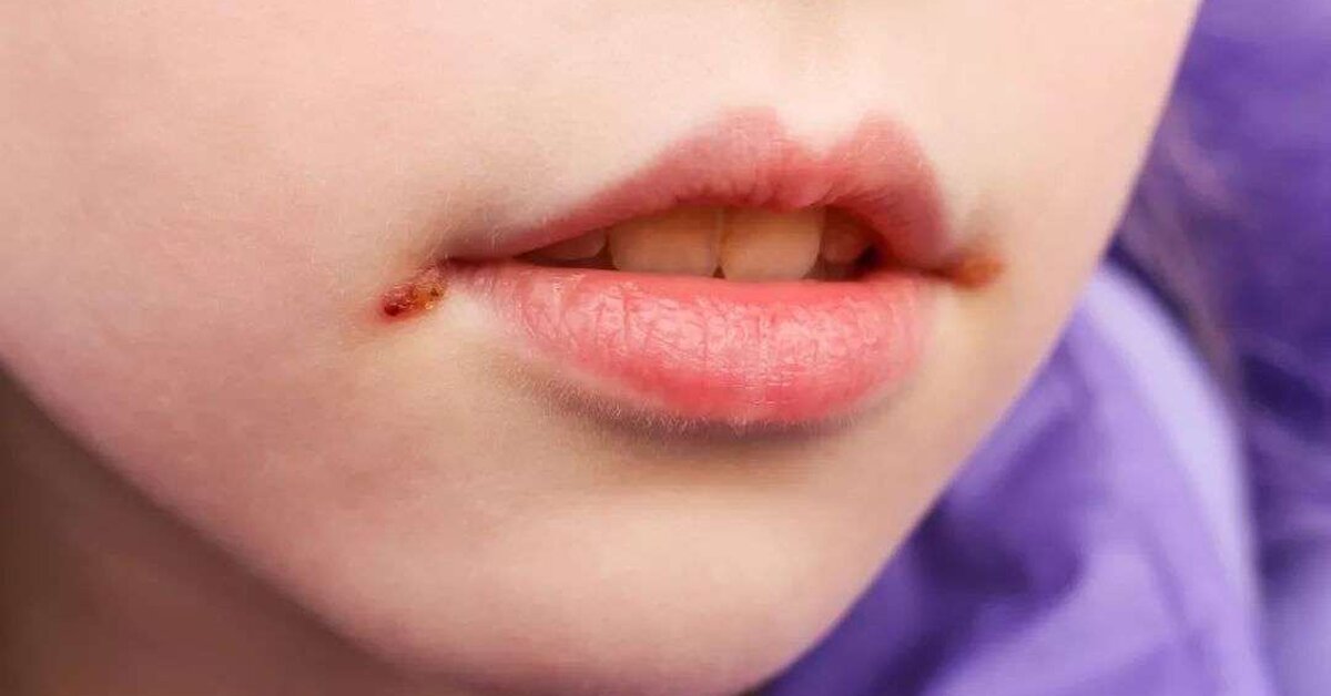 Çocuklarda Ağız Kenarı Yaraları Belirtileri ve Tedavisi