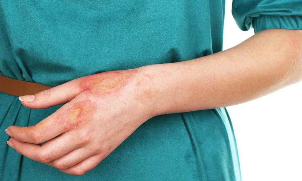 Derinizdeki yaraların temizlenmesi