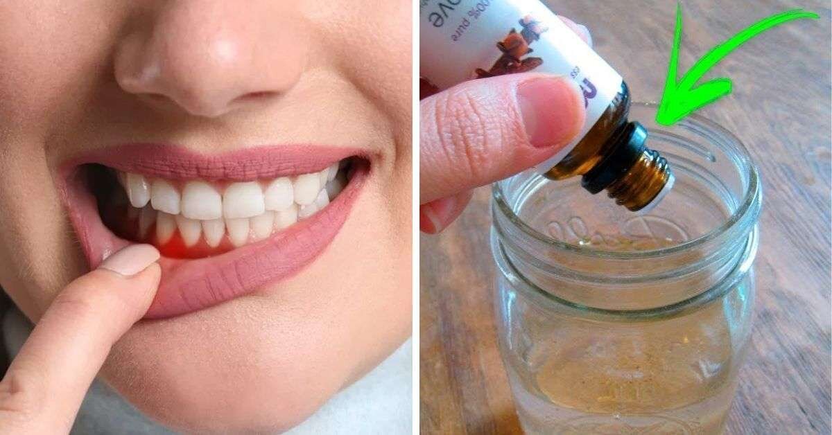 Diş Eti Çekilmesine Ne İyi Gelir? Diş Eti Çekilmesi Doğal Tedavisi