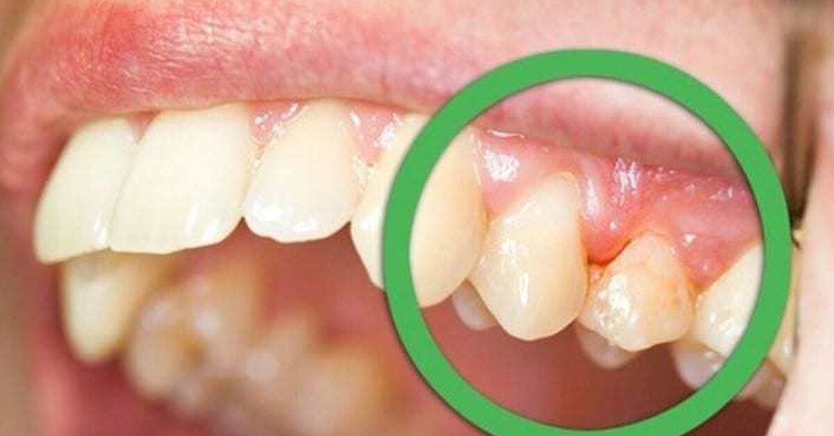 Diş Hekiminizin bilmenizi istemediği 12 Doğal Diş Ağrısı Tedavi Yöntemi