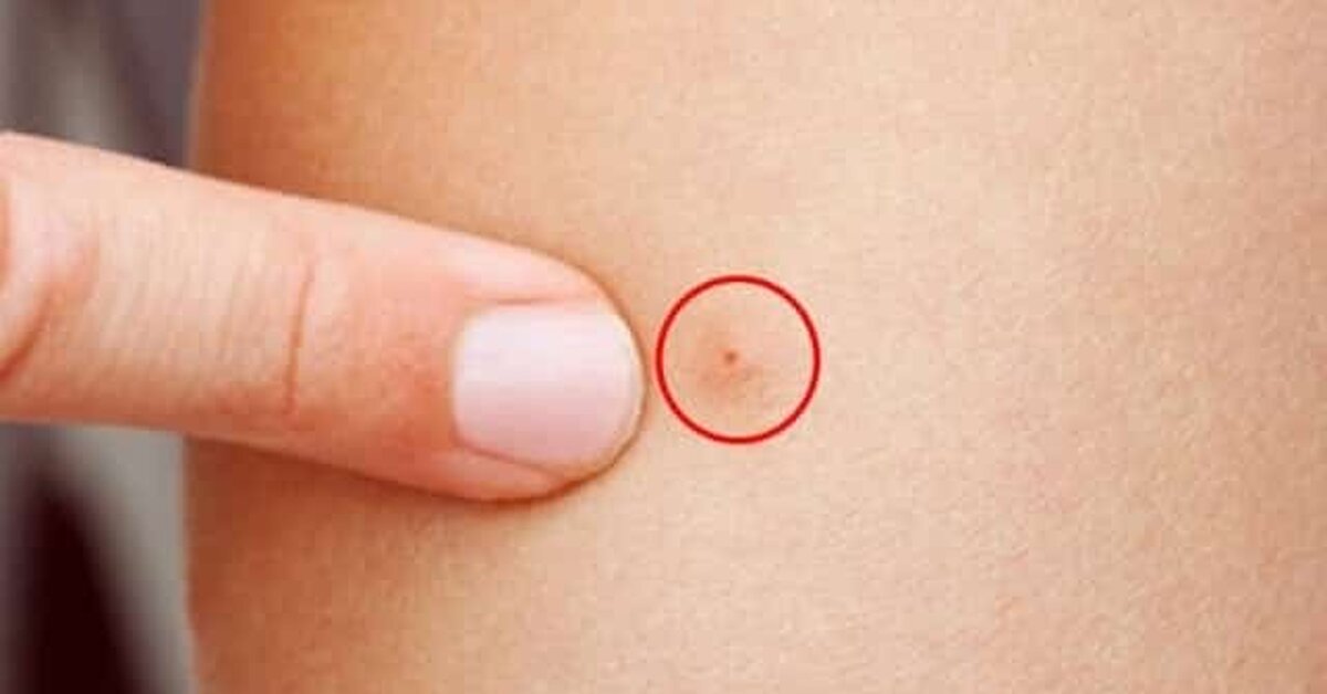 Doktorlar Uyardı! Sivrisinek Isırığından Sonra Mutlaka Bunu Yapın!