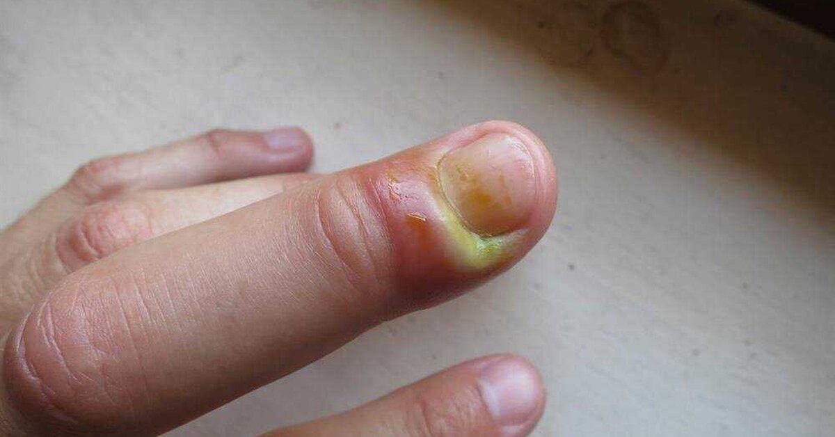 Dolama nedir? Dolama Nasıl Tedavi Edilir? Kesin Çözüm!