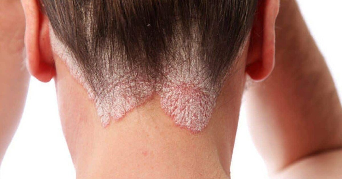 Egzama nedir? Neden olur? Belirtileri ve Tedavisi?