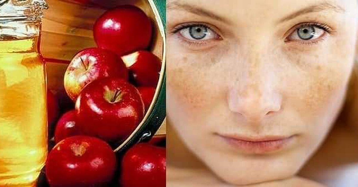 Elma Sirkesi Sayesinde Siyah Noktalardan Kurtulun