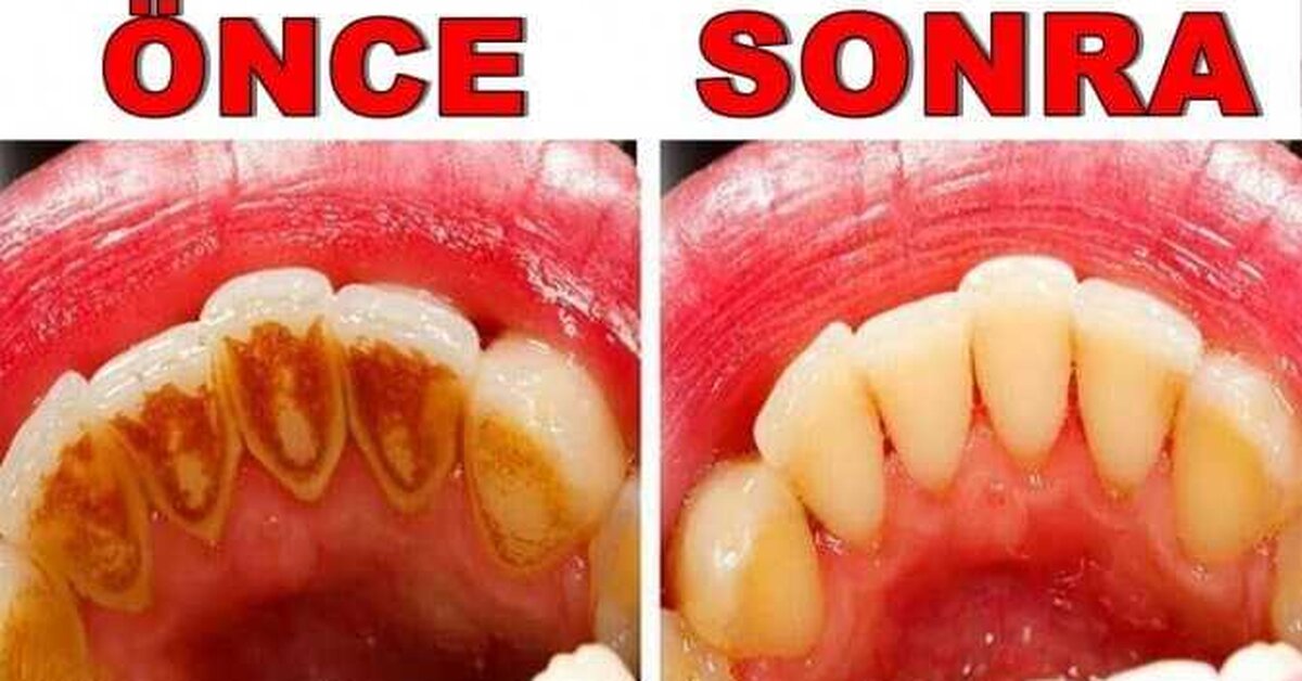 Evde Diş Beyazlatma ve Tartar Temizleme Yöntemleri
