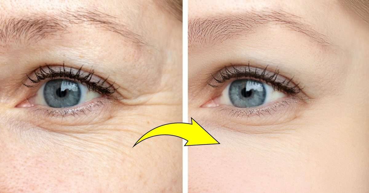 Göz Çevresi Kırışıklıklarından Kurtulmanın En İyi Yolu