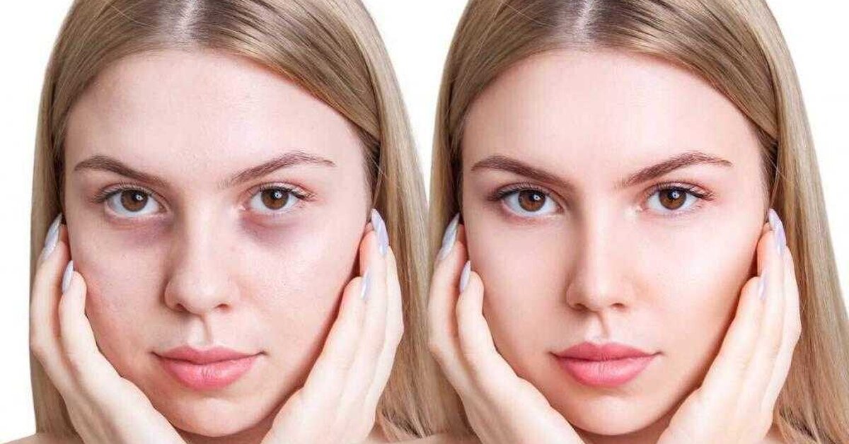 Gözaltı Halkaları ve Tedavi Yöntemleri