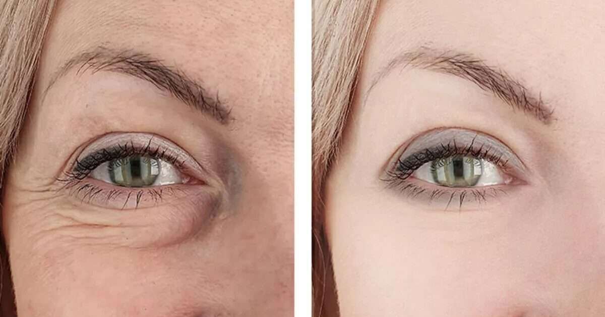 Gözaltı Kırışıklıkları Nasıl Giderilir?