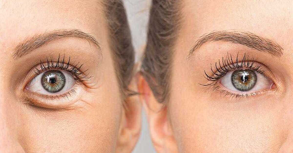 Gözaltı Torbaları Nasıl Geçer?