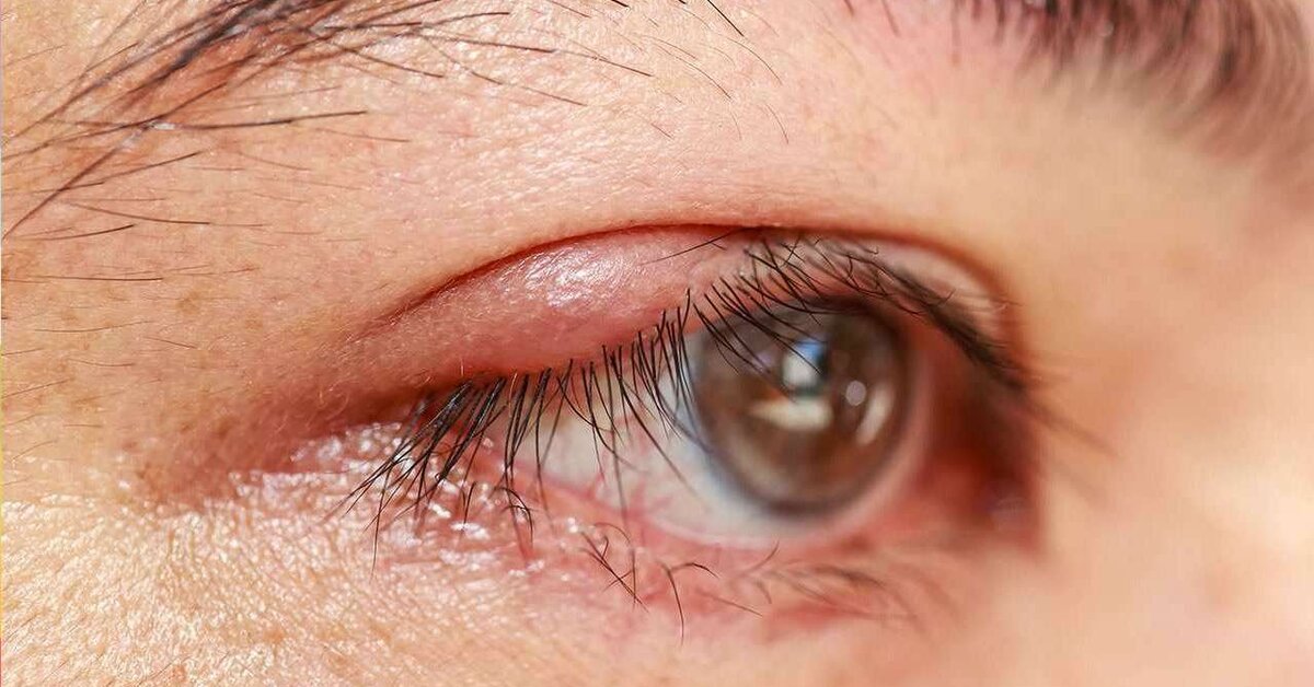 Gözde Arpacık Sorunu İçin Doğal Çözüm!