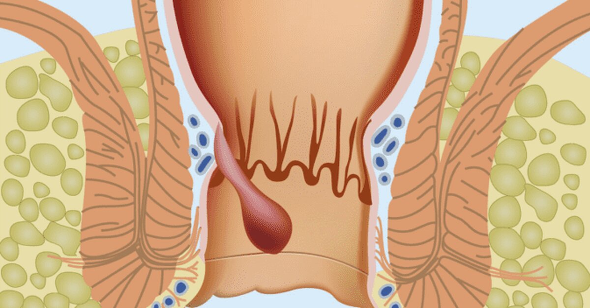 Hemoroit neden olur?