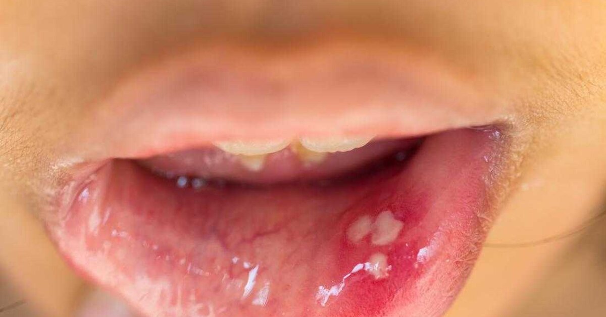 HPV Enfeksiyonu Nedir Belirtileri Nelerdir