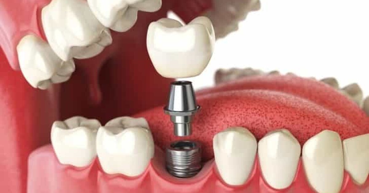 Diş implantı nedir ve nasıl yapılır?