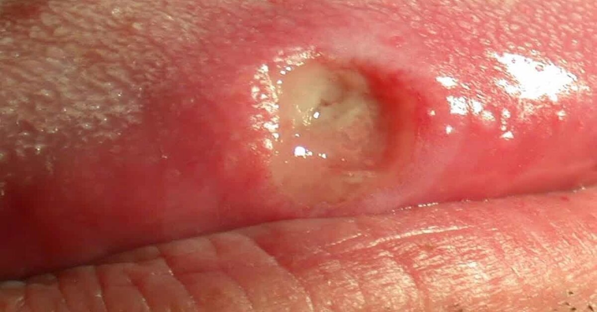 Kadınlarda Kanserin Erken Belirtilerine Dikkat!