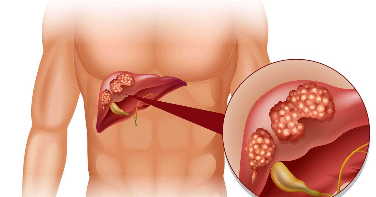 Karaciğer Rahatsızlığını Gösteren Belirtiler Nelerdir?