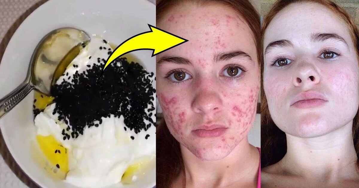 Karaciğer yağlanması sivilce yapar mı?