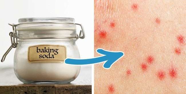 Karbonat Kaşıntıyı Giderir