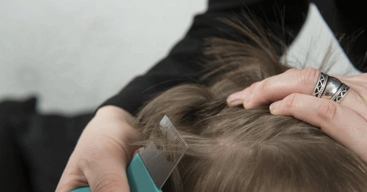 Kepek Derdine Nasıl Son Verebilirsiniz?