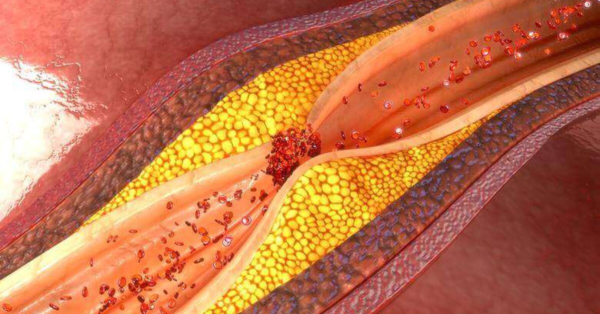 Kolesterol Yüksekliğine Karşı Bitkisel Kür