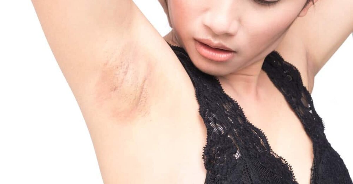 Koltuk Altı Kararmasını Ne Geçirir?