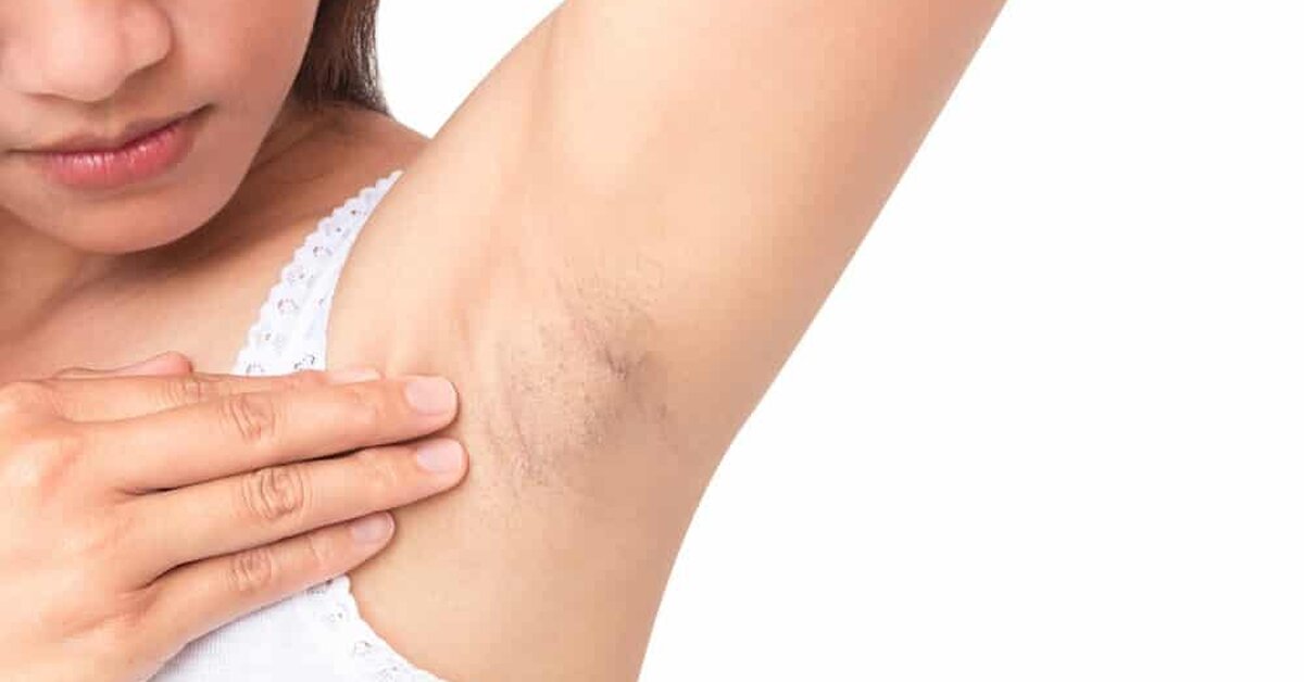 Koltuk Altı Kararmasına Ne İyi Gelir?