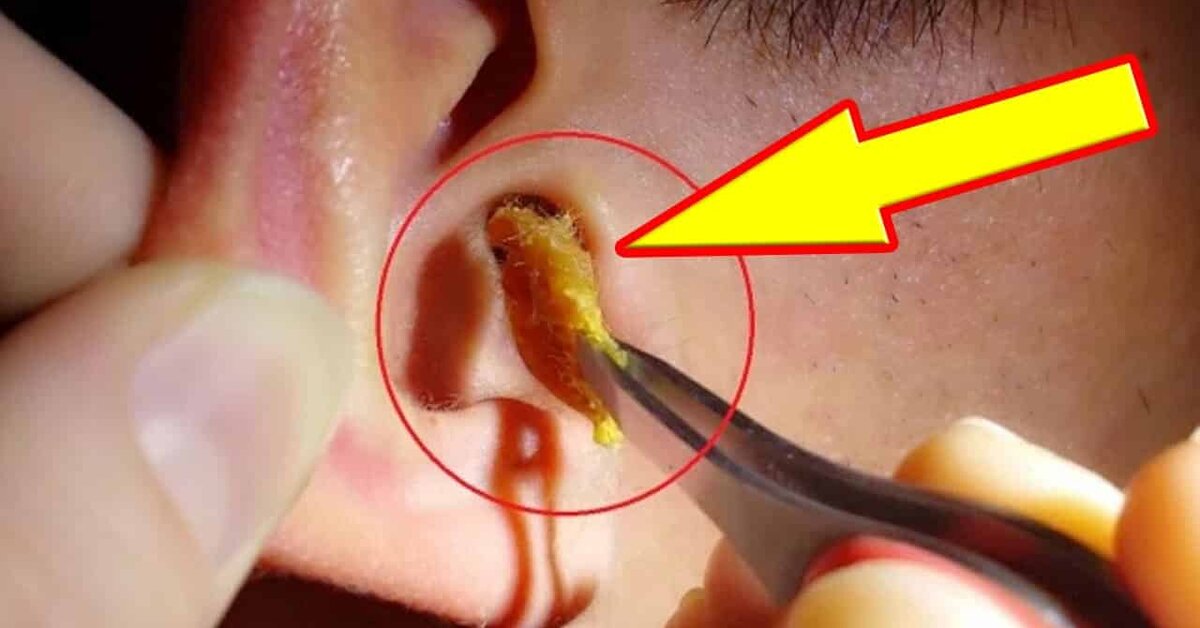 Kulak Kiri Nasıl Temizlenmelidir?