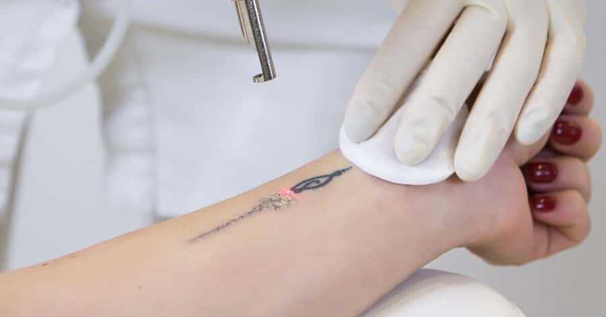 Lazerle Dövme Sildirme Nasıl Yapılır?