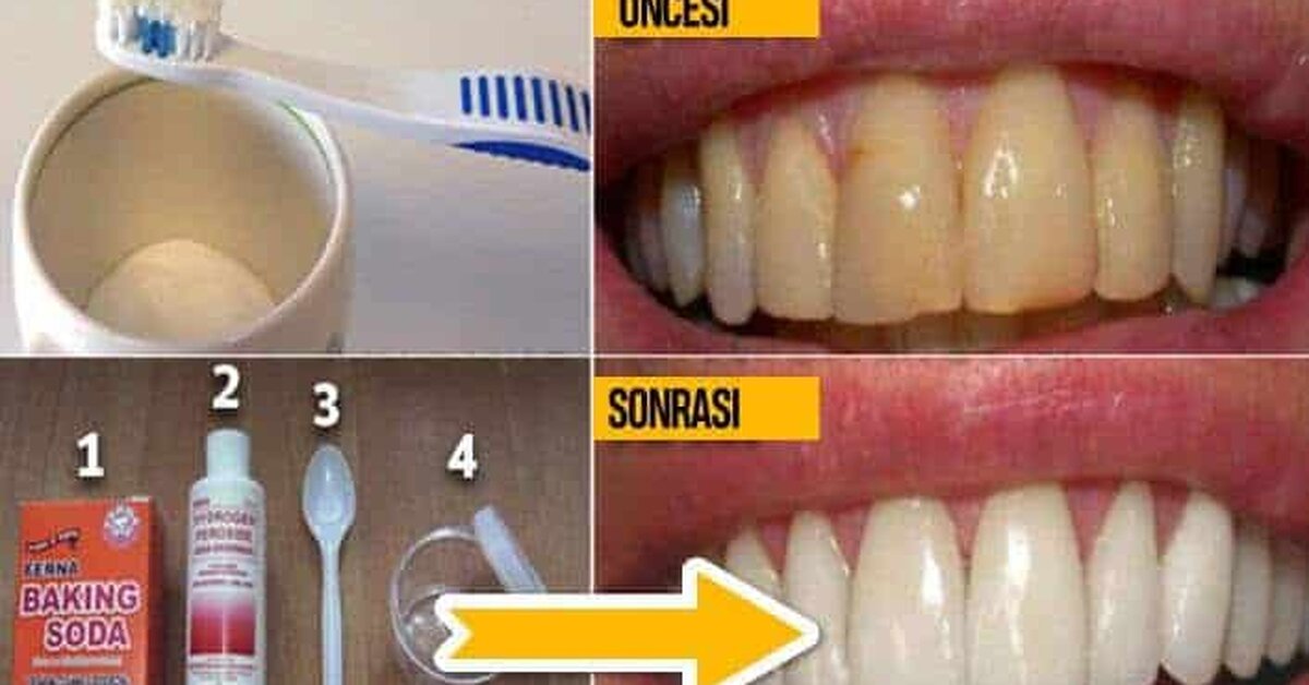 Plaktan Kurtulmanın ve Pahalı Tedaviler Olmadan Dişlerinizi Beyazlatma Çözümleri