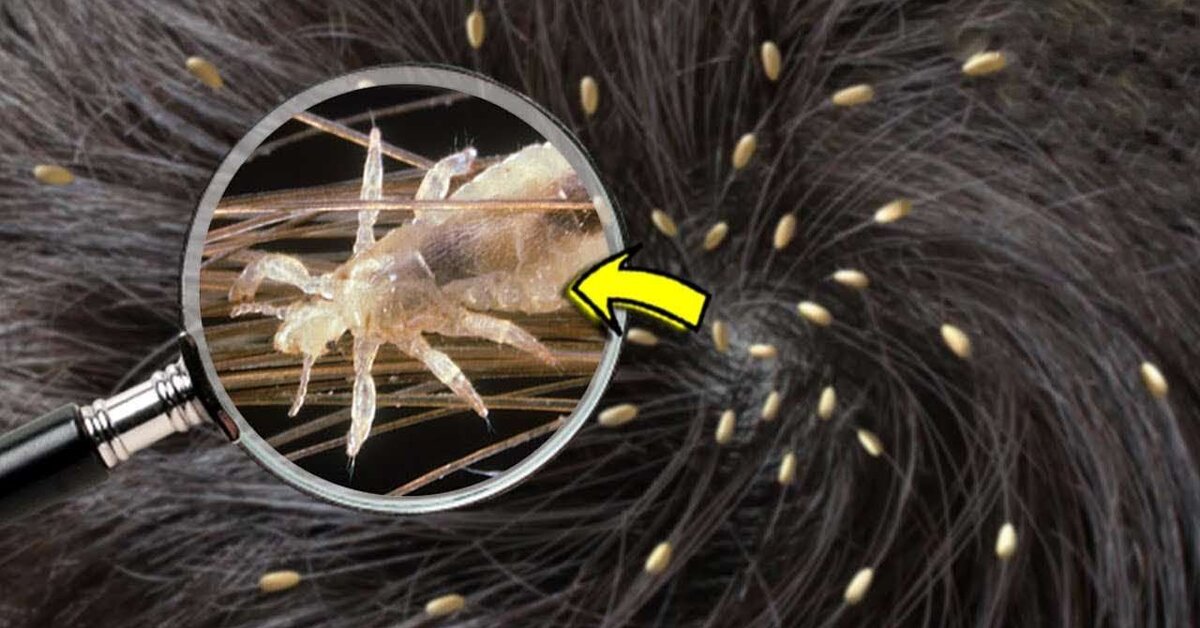 Saç Biti İçin Bitkisel Tedavi Kürü