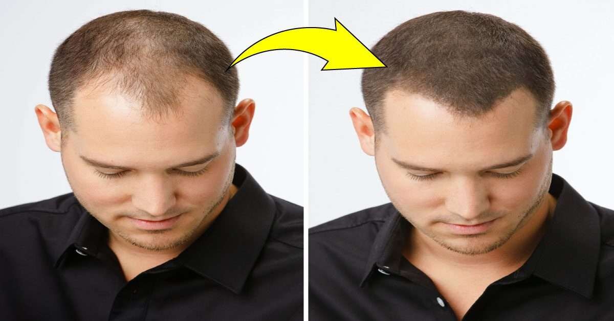 Saç Dökülmesine Kalıcı Çözüm