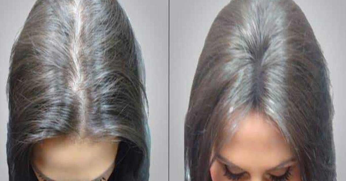 Saç Ekimi Nedir? Nasıl Yapılır?