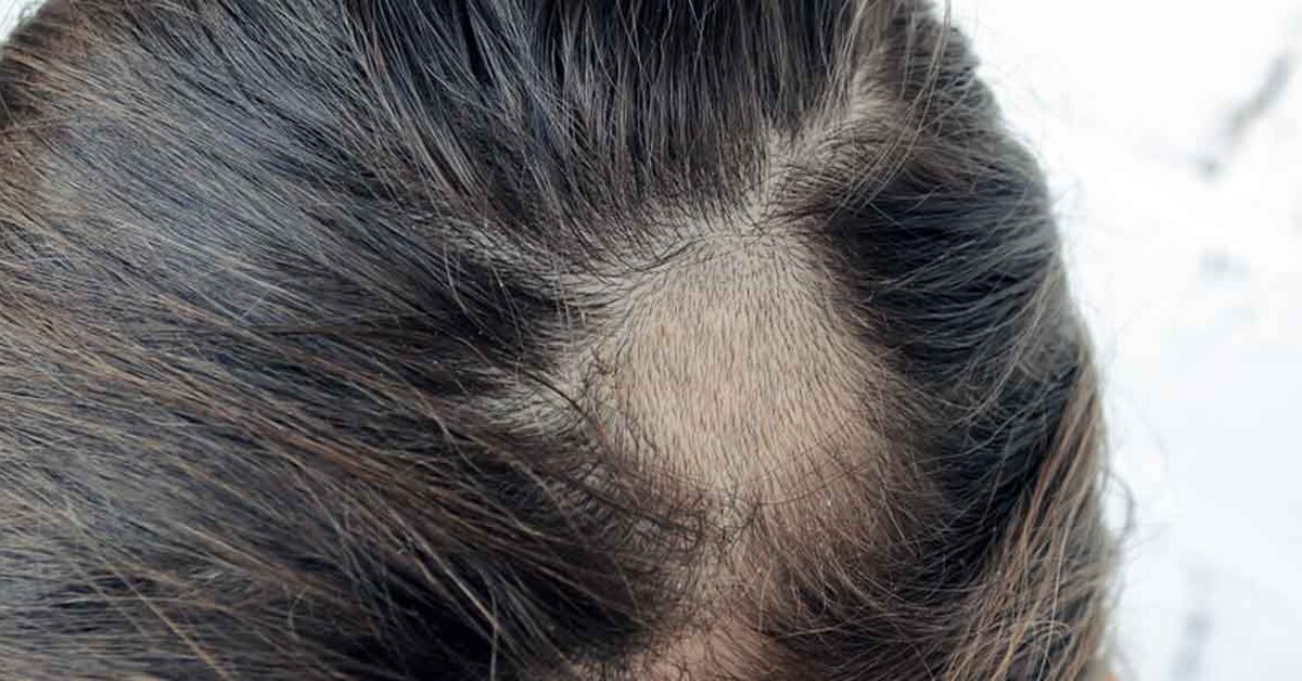 Saç Kıran Neden Olur?