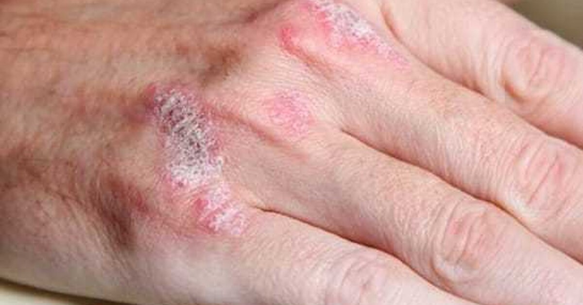 Sedef Tedavisi İçin Bitkisel Kür