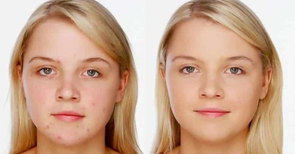 Sivilce Lekelerine Kesin Çözüm!