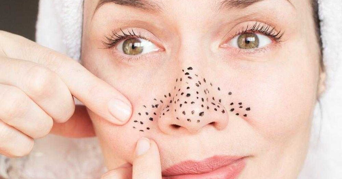 Sivilce ve siyah noktalar nasıl temizlenmeli?