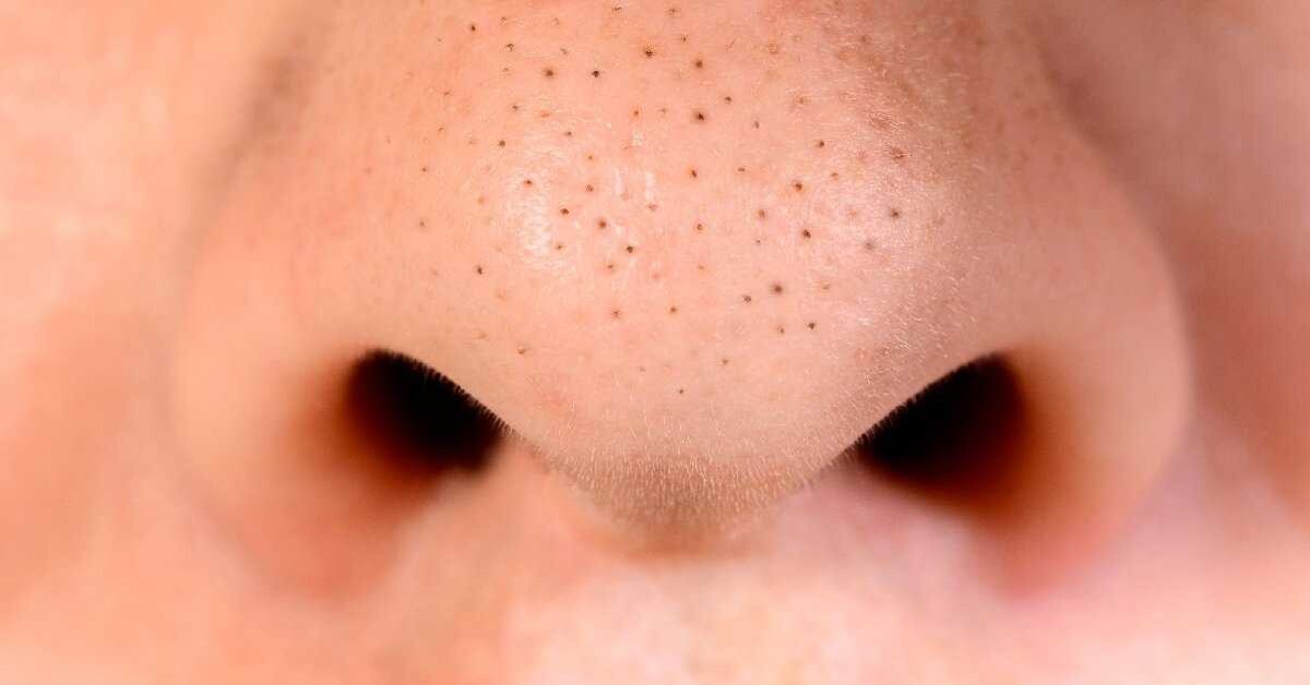 Sivilce ve Siyah Noktalardan Kurtulun!