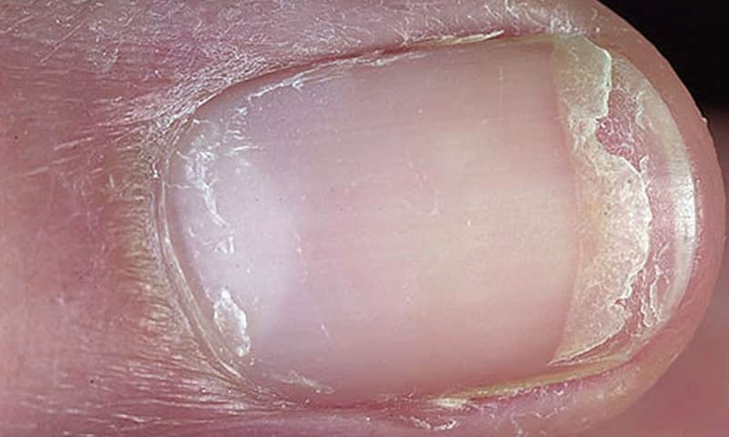 Kırılgan Tırnaklar