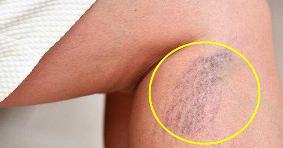 Süt ile Varis Tedavisi