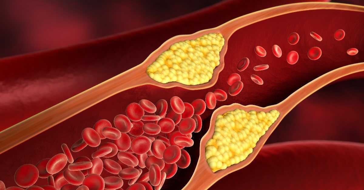 Kalp Damar Tıkanıklığına Doğal Çözüm