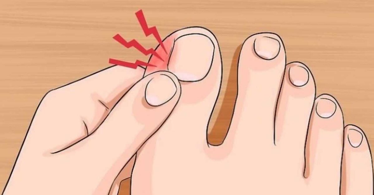 Tırnak batması nasıl geçer? Tırnak batmasına doğal çözüm!